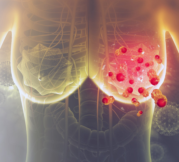 Inteligencia artificial, aliada contra el cáncer