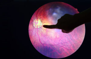 IA en oftalmología: una nueva solución IA en oftalmología